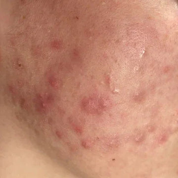 Acne & Breakouts
