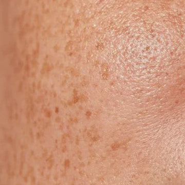 Dull & Uneven Skin Tone