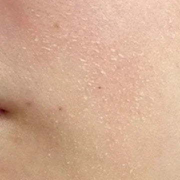 Dry & Dehydrated Skin