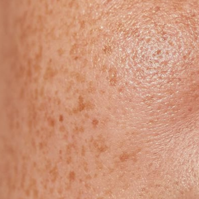 Dull & Uneven Skin Tone
