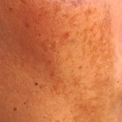 Dark Spots & Pigmentation
