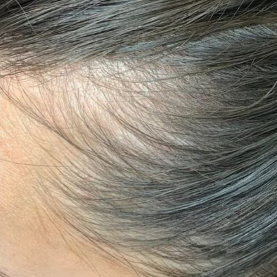 Hair Fall & Thinning